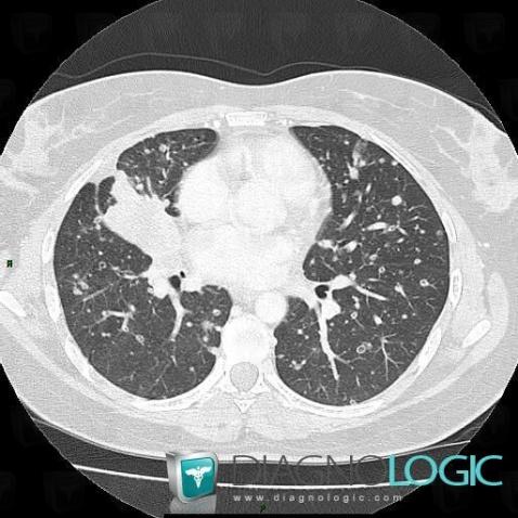 Bronchogenic carcinoma, Pulmonary parenchyma, CT