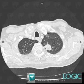 Bronchogenic carcinoma, Pulmonary parenchyma, CT