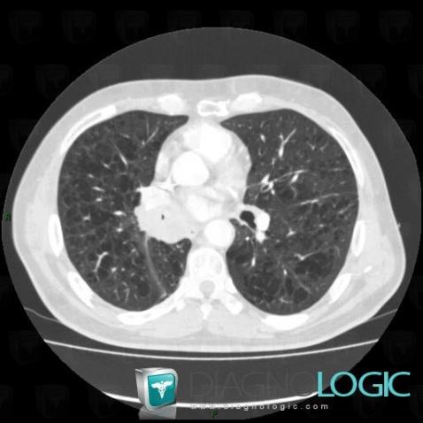 Bronchogenic carcinoma, Pulmonary parenchyma, CT