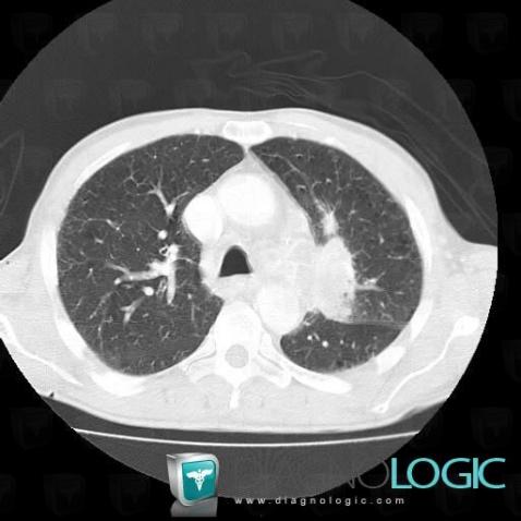 Bronchogenic carcinoma, Pulmonary parenchyma, CT