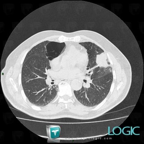 Bronchogenic carcinoma, Pulmonary parenchyma, CT