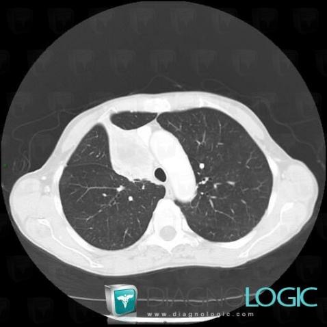 Bronchogenic carcinoma, Pulmonary parenchyma, CT