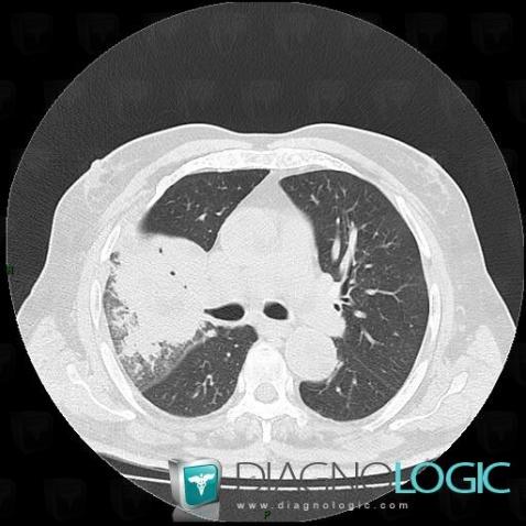 Bronchogenic carcinoma, Pulmonary parenchyma, CT