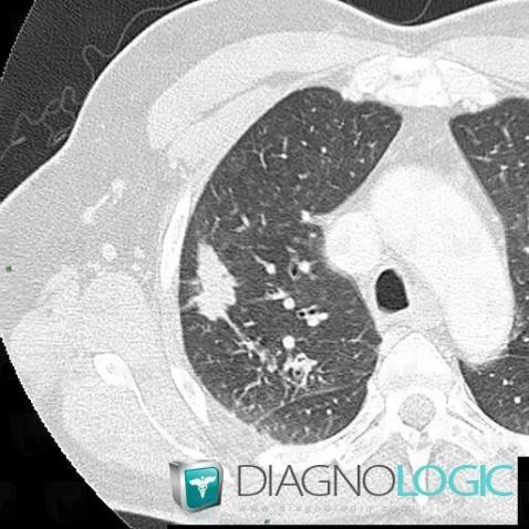 Bronchogenic carcinoma, Pulmonary parenchyma, CT