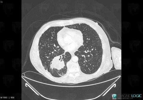 Bronchogenic carcinoma, Pulmonary parenchyma, CT