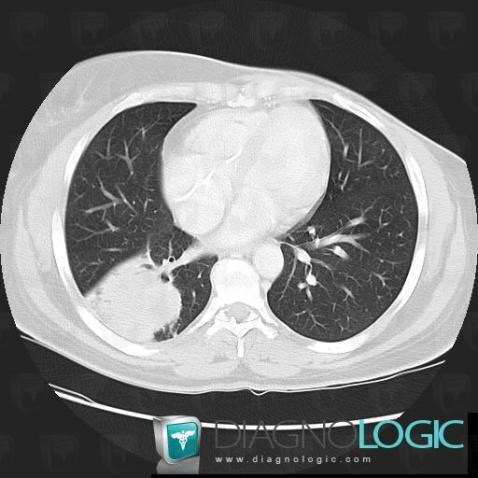 Bronchogenic carcinoma, Pulmonary parenchyma, CT