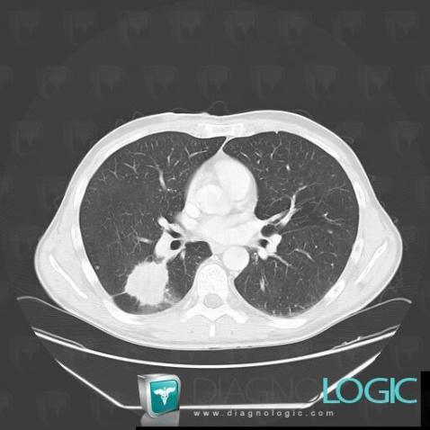 Bronchogenic carcinoma, Pulmonary parenchyma, CT