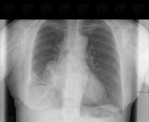 Bronchogenic carcinoma, Pulmonary parenchyma, Hila, X rays