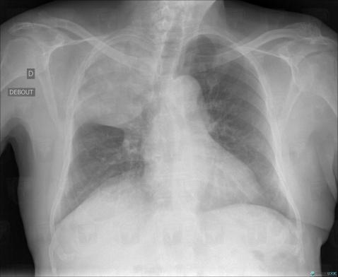 Bronchogenic carcinoma, Pulmonary parenchyma, X rays