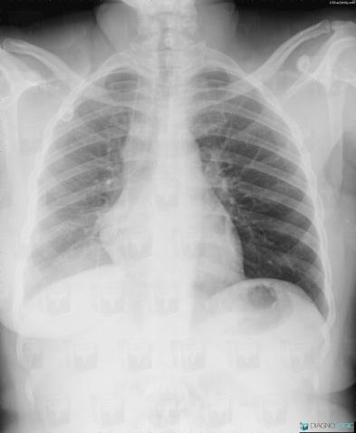 Bronchogenic carcinoma, Pulmonary parenchyma, X rays