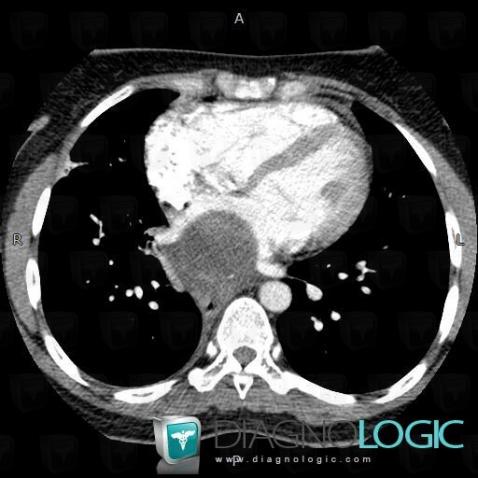 Bronchogenic cyst, Mediastinum, CT