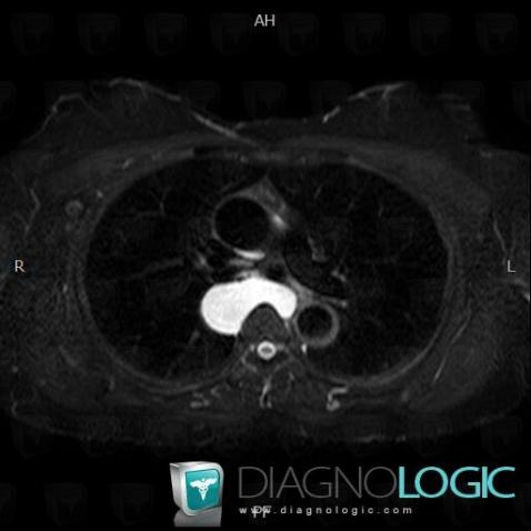 Bronchogenic cyst, Mediastinum, MRI