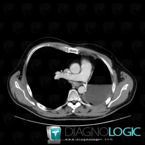 Bronchopleural fistula, Airways, CT