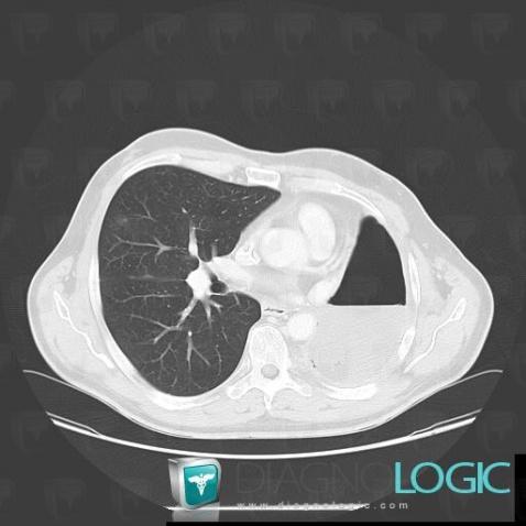 Bronchopleural fistula, Pleura, CT