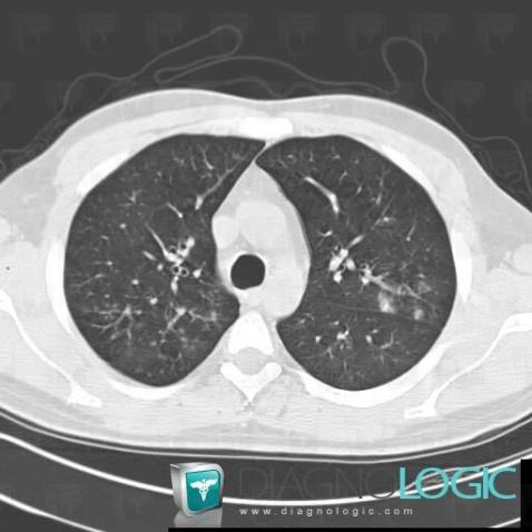 Bronchopneumonia, Pulmonary parenchyma, CT