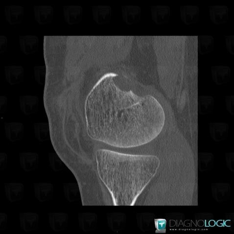 Brown tumor-hyperparathyroidism, Femur - Distal part, CT