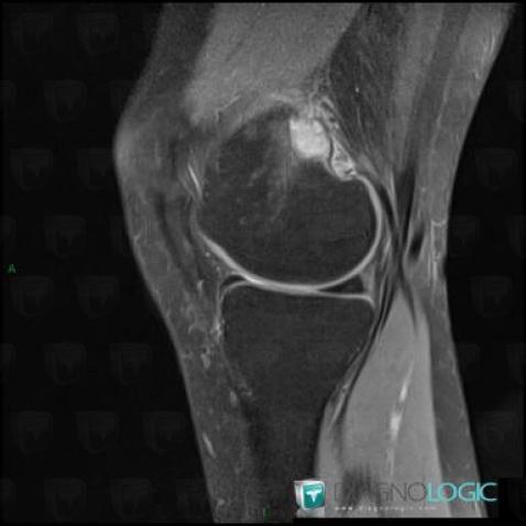 Brown tumor-hyperparathyroidism, Femur - Distal part, MRI