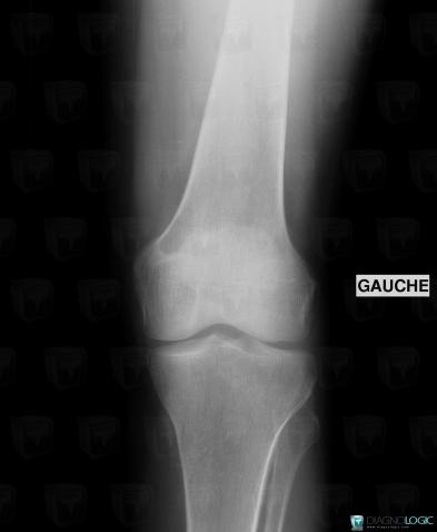 Brown tumor-hyperparathyroidism, Femur - Distal part, X rays