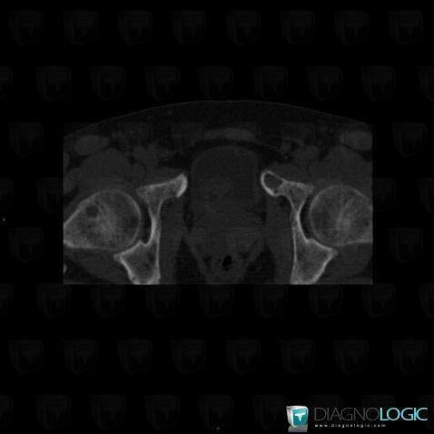 Brown tumor-hyperparathyroidism, Femur - Proximal part, CT