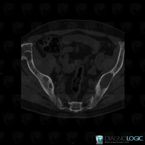 Brown tumor-hyperparathyroidism, Ilium, CT