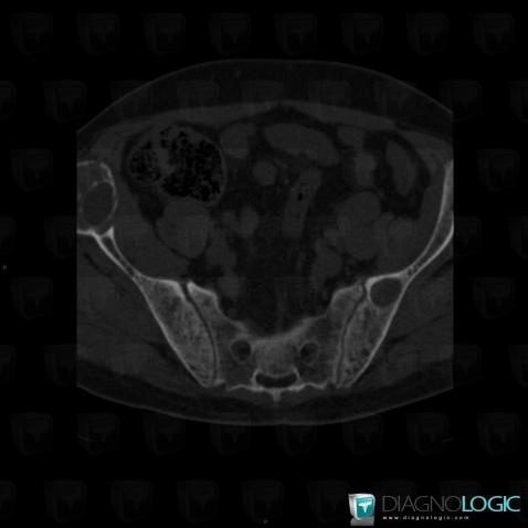 Brown tumor-hyperparathyroidism, Ilium, CT