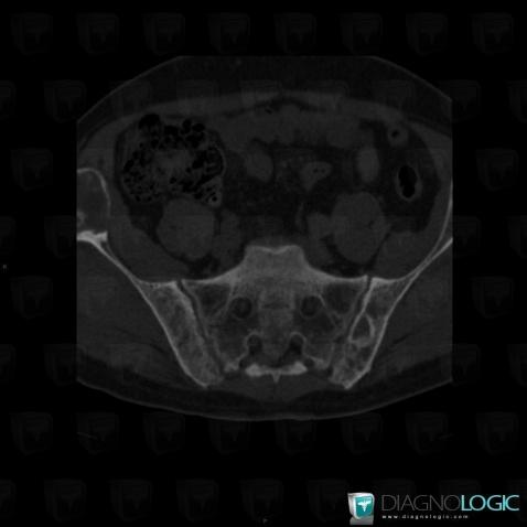 Brown tumor-hyperparathyroidism, Ilium, CT