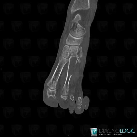 Brown tumor-hyperparathyroidism, Metatarsal bones, CT