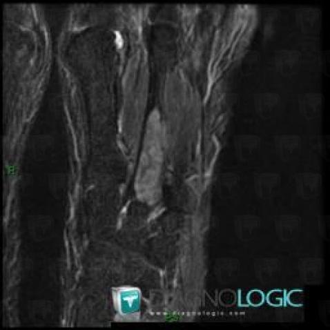 Radiology case : Brown tumor of hyperparathyroidism (MRI ,CT ,X rays ...