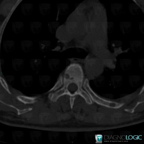 Brown tumor-hyperparathyroidism, Ribs, CT