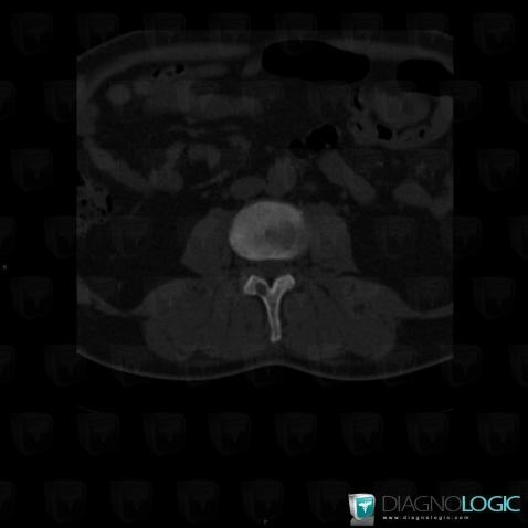 Brown tumor-hyperparathyroidism, Vertebral body / Disk, CT