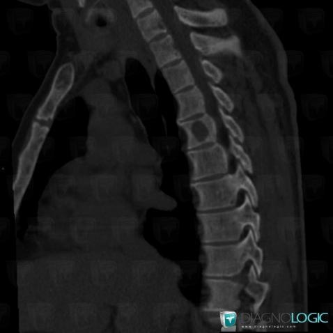 Brown tumor-hyperparathyroidism, Vertebral body / Disk, CT