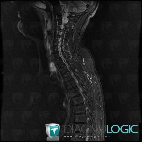 Brown tumor-hyperparathyroidism, Vertebral body / Disk, MRI