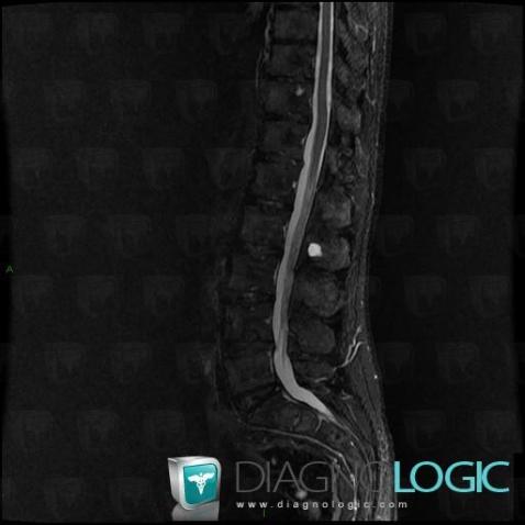 Brown tumor-hyperparathyroidism, Vertebral body / Disk, MRI