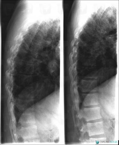 Brown tumor-hyperparathyroidism, Vertebral body / Disk, X rays