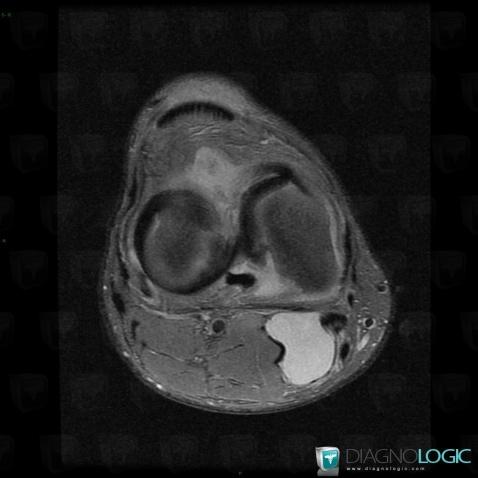 Bucket handle tear, Femorotibial joints - Intercondylar notch, Meniscus, MRI