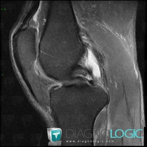 Bucket handle tear, Femorotibial joints - Intercondylar notch, Meniscus, MRI