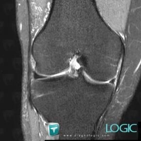 Bucket handle tear, Femorotibial joints - Intercondylar notch, Meniscus, MRI