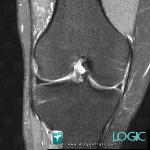 Bucket handle tear, Femorotibial joints - Intercondylar notch, Meniscus, MRI