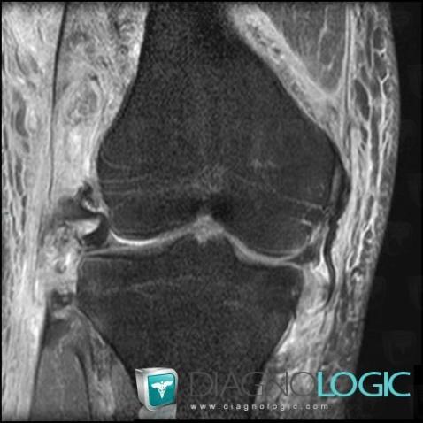 Bucket handle tear, Meniscus, MRI