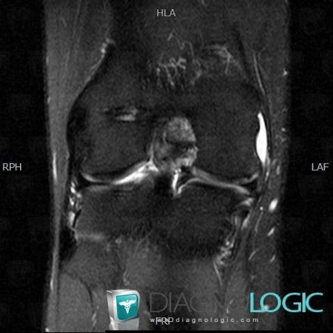 Bursitis, Medial collateral ligament - Knee, Other soft tissues/nerves - Knee, MRI