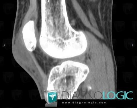 Bursitis, Other soft tissues/nerves - Knee, CT