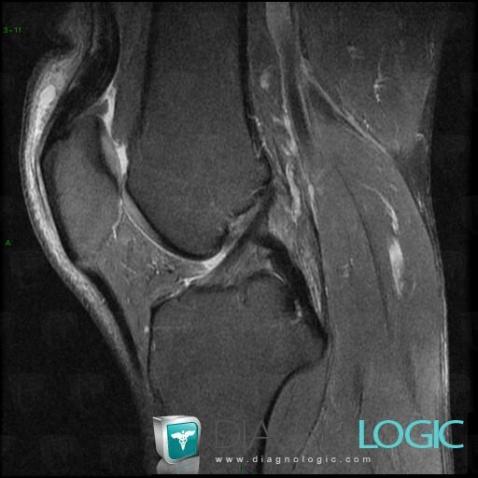 Radiology case : Bursitis (MRI) - Diagnologic