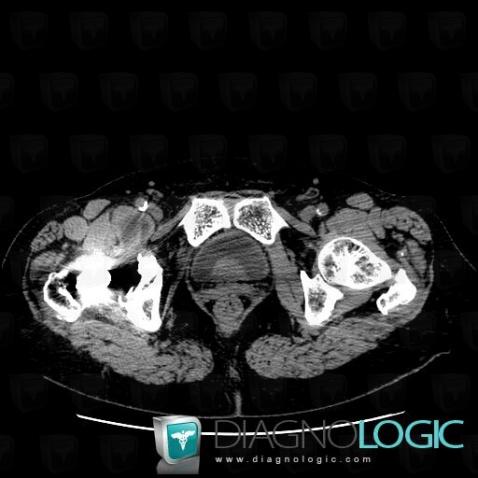 Bursitis, Other soft tissues/nerves - Pelvis, CT