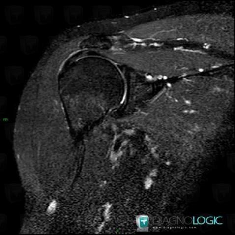 Bursitis, Other soft tissues/nerves - Shoulder, MRI