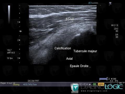 Bursitis, Other soft tissues/nerves - Shoulder, US