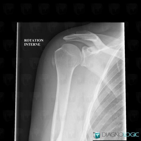 Bursitis, Other soft tissues/nerves - Shoulder, X rays