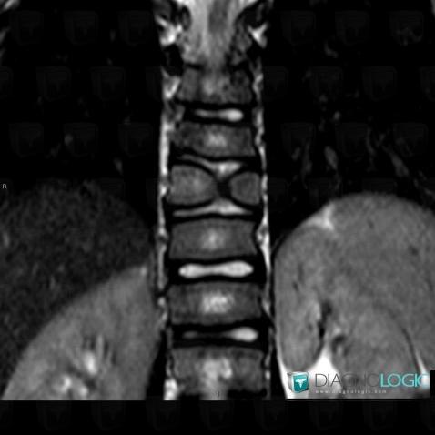 Butterfly Vertebra, Vertebral body / Disk, MRI