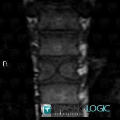 Butterfly Vertebra, Vertebral body / Disk, MRI