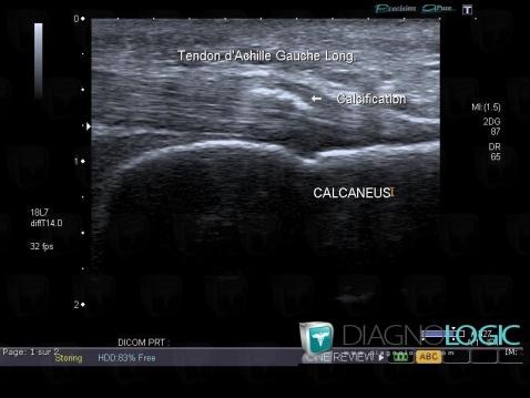 Calcaneal enthesopathy, Calcaneal tendon - Ankle, US