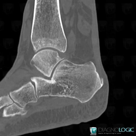 Calcaneal enthesopathy, Calcaneal tendon - Ankle, X rays